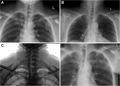 Catheter malposition analysis of totally implantable venous access port in breast cancer patients